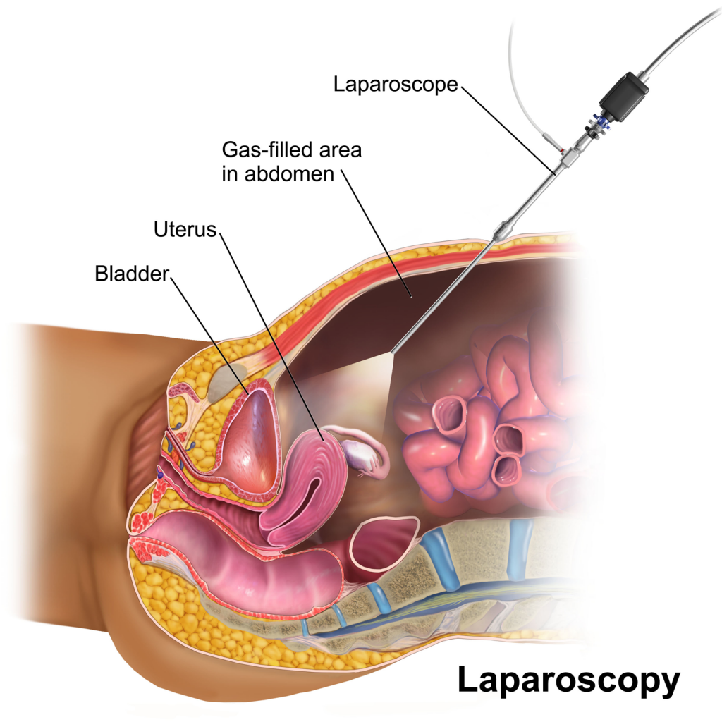 Pregnancy after laparoscopy